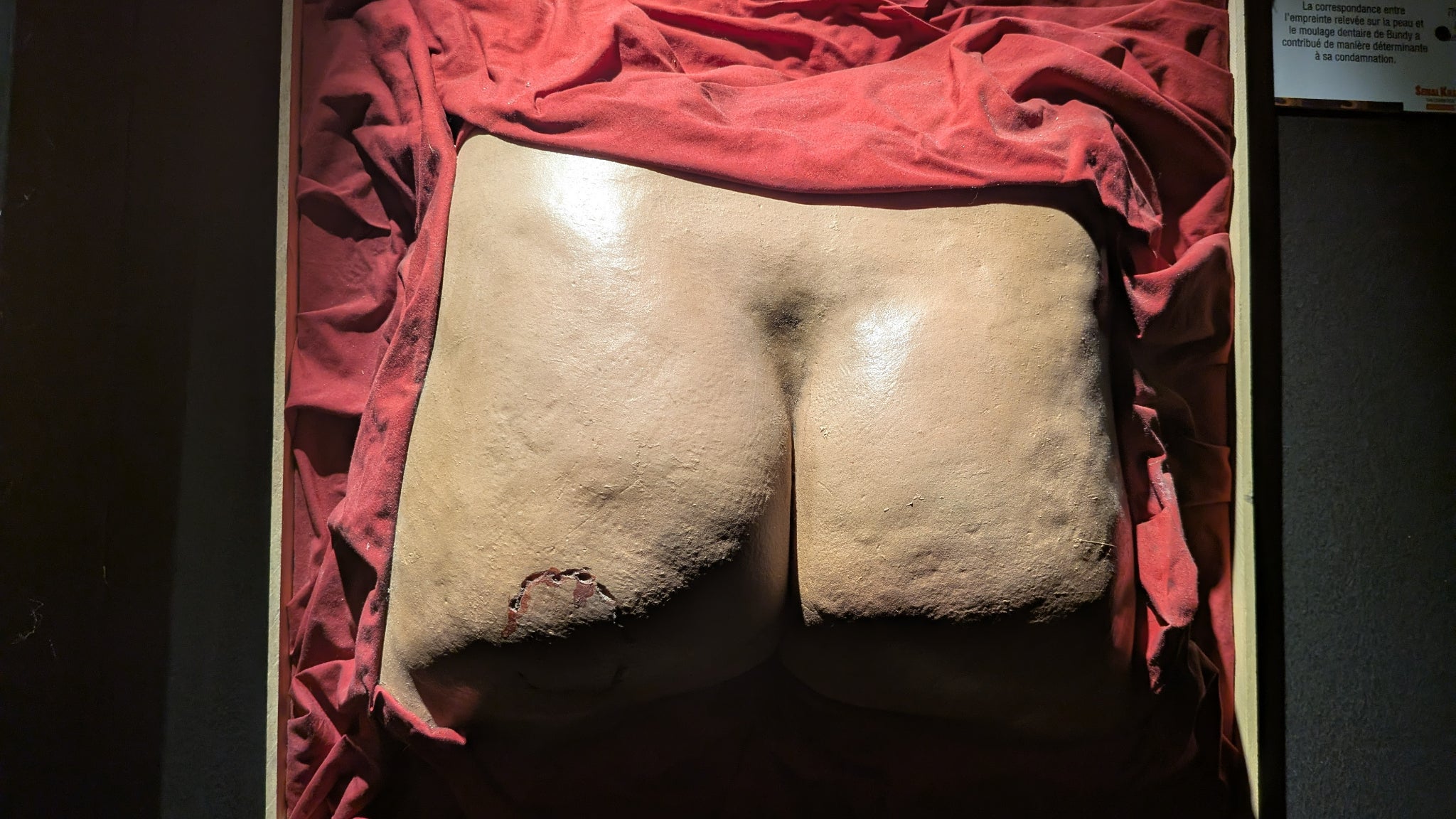Le moulage de la morsure de Ted Bundy sur les fesses de l'une de ses victimes