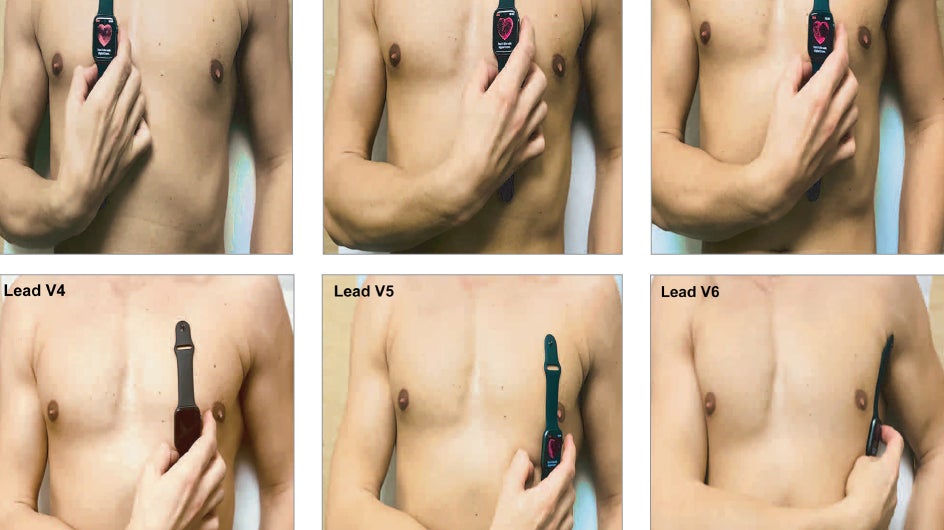 L'étude a utilisé l'Aple Watch de la même façon que les électrodes d'un ECG 